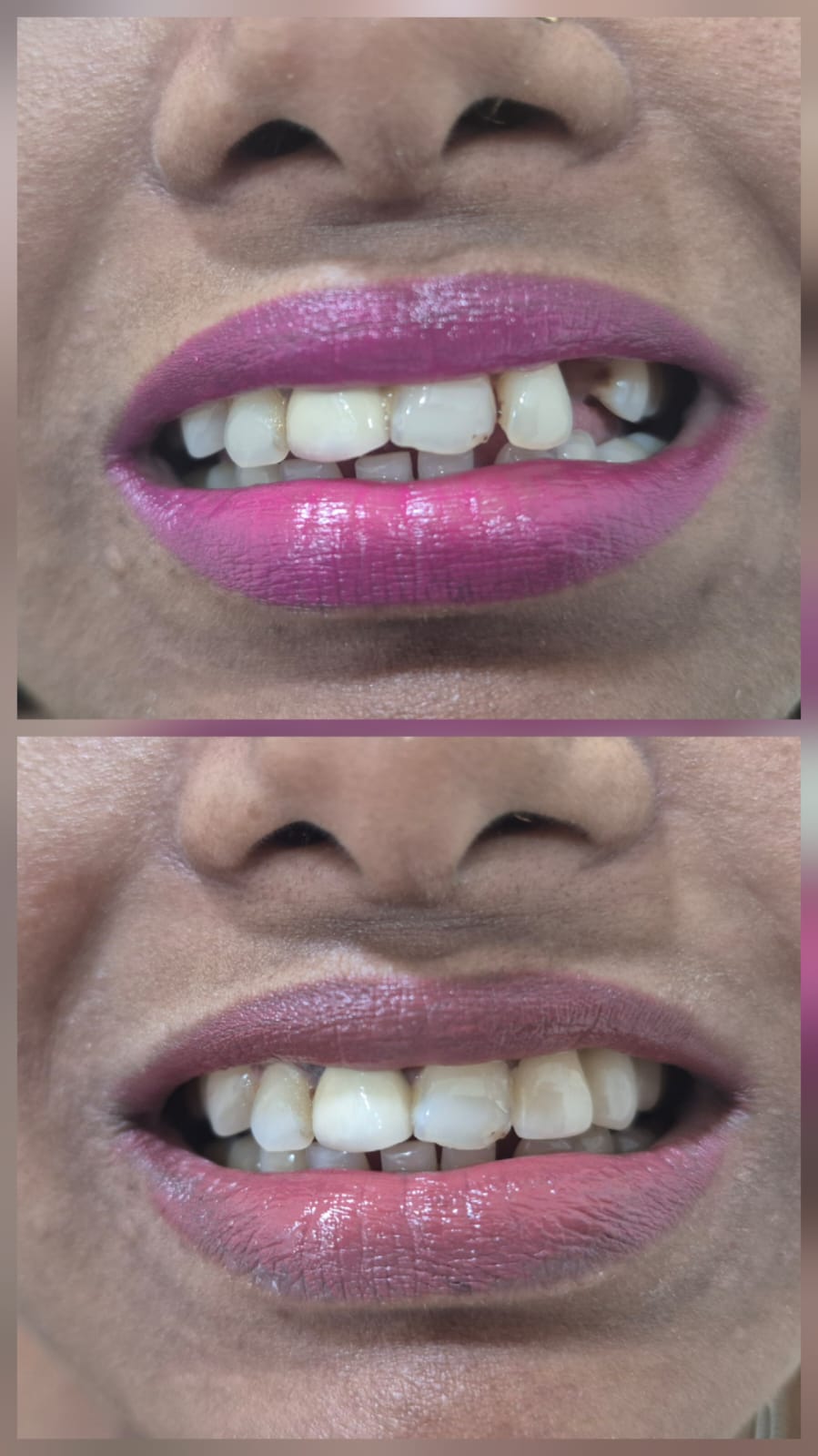 Before and after smile transformation 10